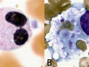 Transient Pelgeroid Change of Neutrophils in Hemophagocytic Lymphohistiocytosis