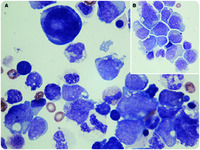 Cytospin preparation of AML in pleural fluid