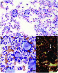 Lymphoma and gout coexisting in the same joint fluid