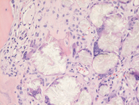 Bone marrow oxalosis