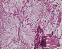 Oxalate crystals in bone marrow 2