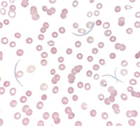 Immunoglobulin Crystals in Plasma Cell Leukemia 2